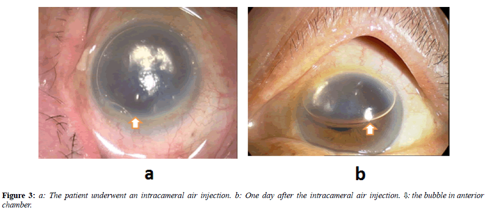 clinical-ophthalmology-vision-science-intracameral-air