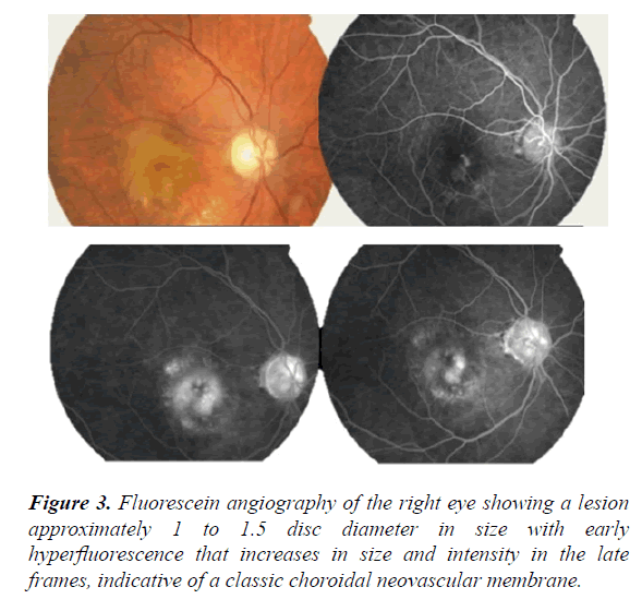 clinical-ophthalmology-vision-science-lesion