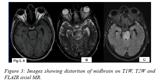 clinical-ophthalmology-vision-science-midbrain