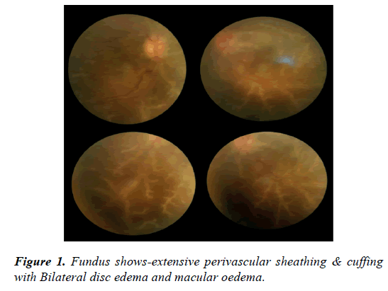 clinical-ophthalmology-vision-science-perivascular