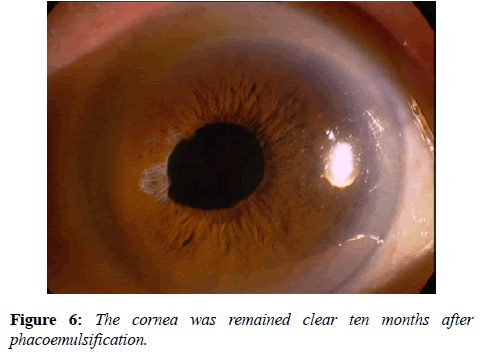 clinical-ophthalmology-vision-science-phacoemulsification