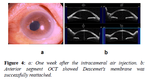 clinical-ophthalmology-vision-science-successfully-reattached