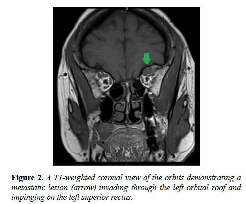 clinical-ophthalmology-vision-science-superior-rectus