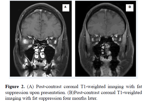 clinical-ophthalmology-vision-science-suppression