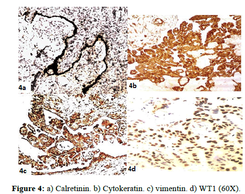 clinical-pathology-Cytokeratin-vimentin