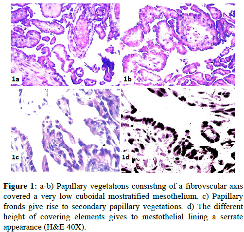 clinical-pathology-Papillary-vegetations