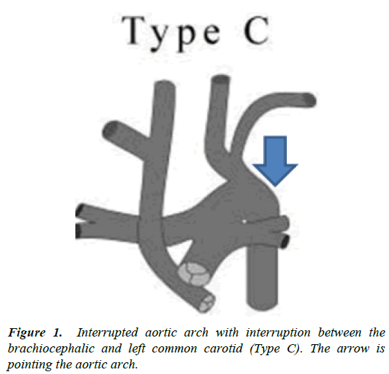 clinical-pathology-laboratory-medicine-Interrupted-aortic-arch