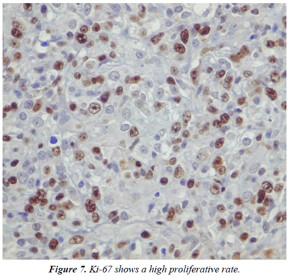 clinical-pathology-laboratory-medicine-high-proliferative