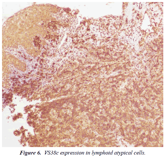 clinical-pathology-laboratory-medicine-lymphoid-atypical