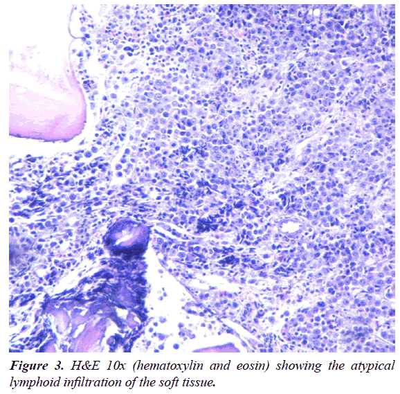 clinical-pathology-laboratory-medicine-lymphoid-infiltration