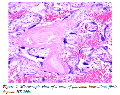 clinical-pathology-laboratory-medicine-placental-intervillous-fibrin