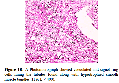 clinical-pathology-signet-ring