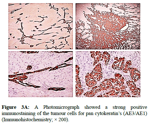 clinical-pathology-tumour-cells