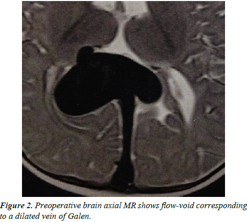 cognitive-neuroscience-dilated-vein