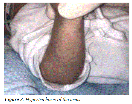 current-pediatric-research-Hypertrichosis