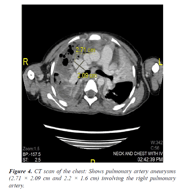 current-pediatric-research-aneurysms