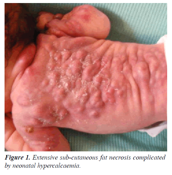 current-pediatric-research-hypercalcaemia