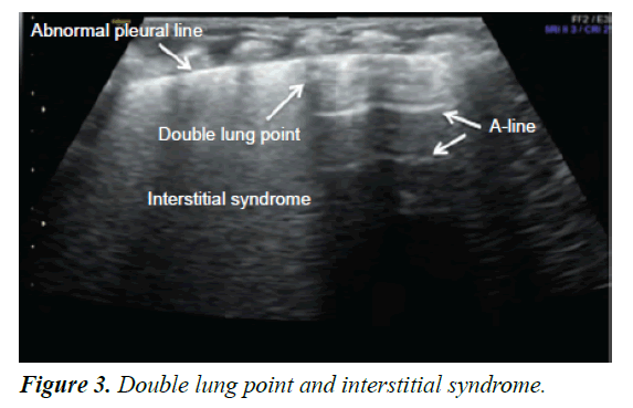 current-pediatric-research-interstitial-syndrome