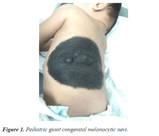 current-pediatric-research-melanocytic-nevi
