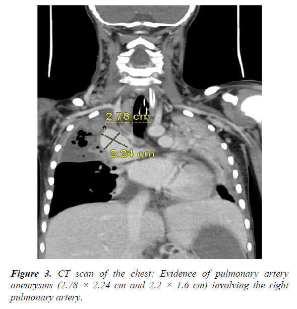 current-pediatric-research-pulmonary-artery