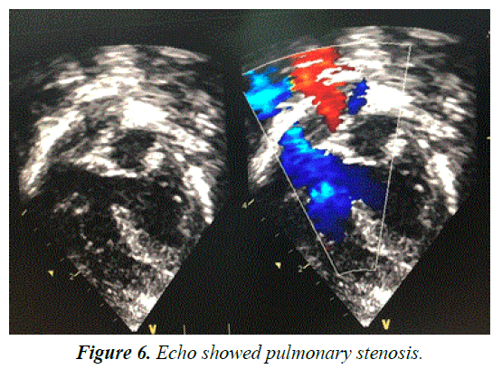 current-pediatric-research-pulmonary-stenosis