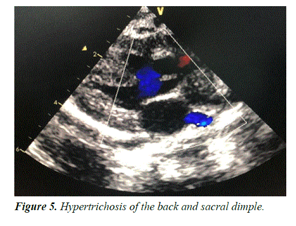 current-pediatric-research-sacral-dimple