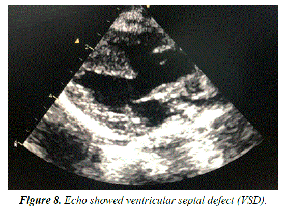 current-pediatric-research-septal-defect