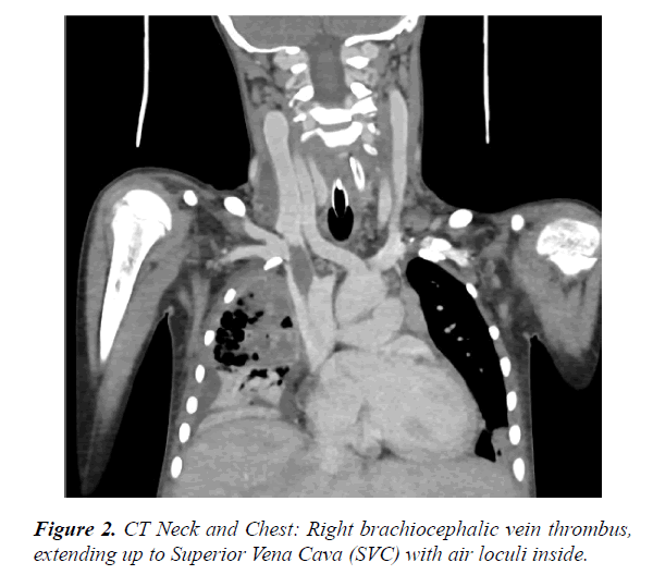 current-pediatric-research-vein-thrombus