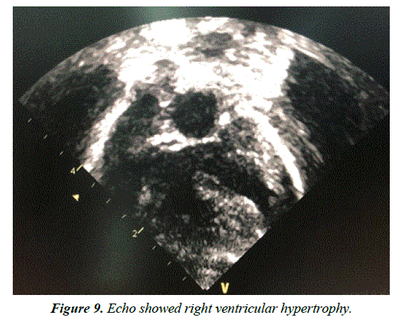 current-pediatric-research-ventricular-hypertrophy