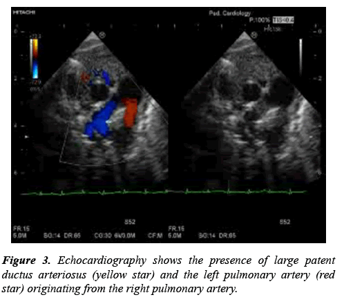 current-pediatrics-arteriosus