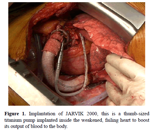 current-trends-cardiology-Implantation-JARVIK