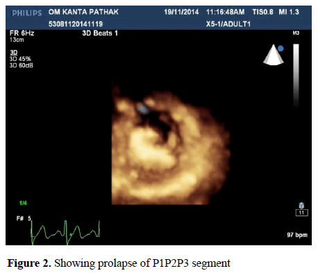 current-trends-cardiology-Showing-prolapse