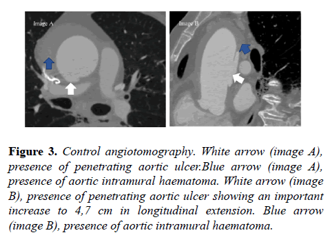 current-trends-cardiology-haematoma