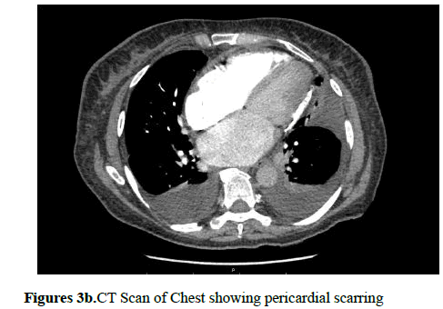 current-trends-cardiology-pericardial-scarring