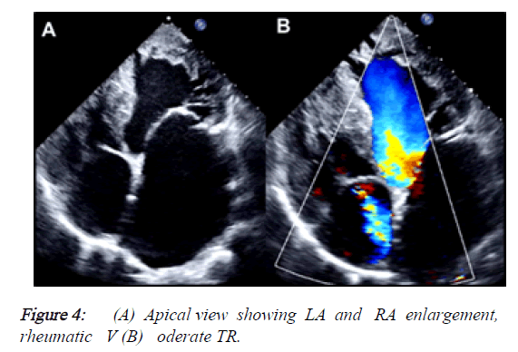 current-trends-in-cardiology-Apical