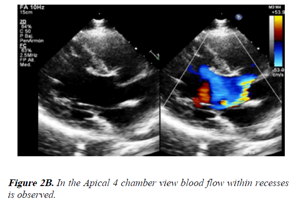 current-trends-in-cardiology-Apical