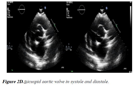 current-trends-in-cardiology-Bicuspid