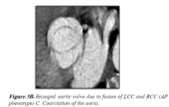 current-trends-in-cardiology-Bicuspid