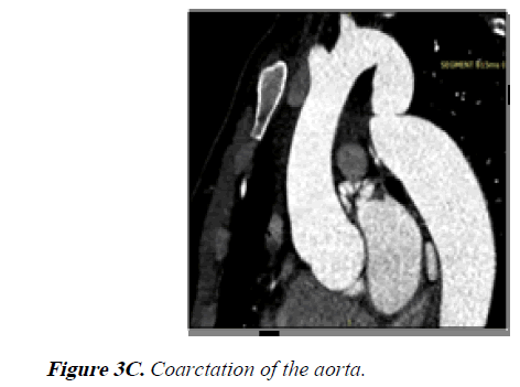 current-trends-in-cardiology-Coarctation