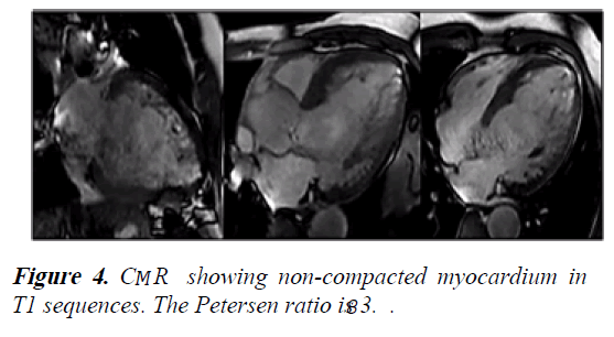 current-trends-in-cardiology-non-compacted