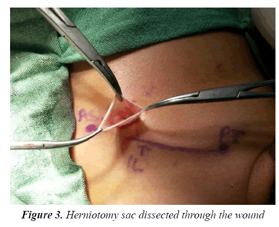 currentpediatrics-Herniotomy-sac