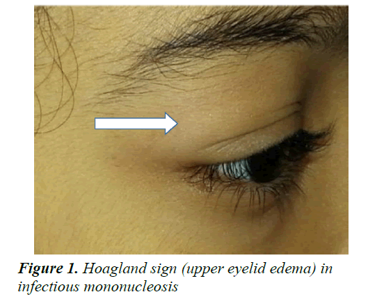 currentpediatrics-Hoagland-sign