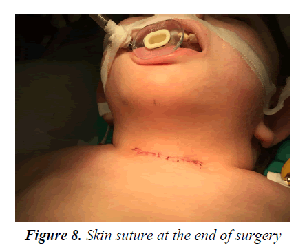 currentpediatrics-Skin-suture