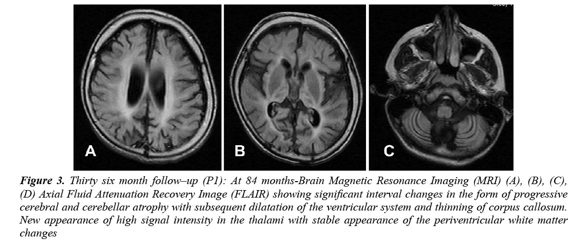 currentpediatrics-cerebellar-atrophy