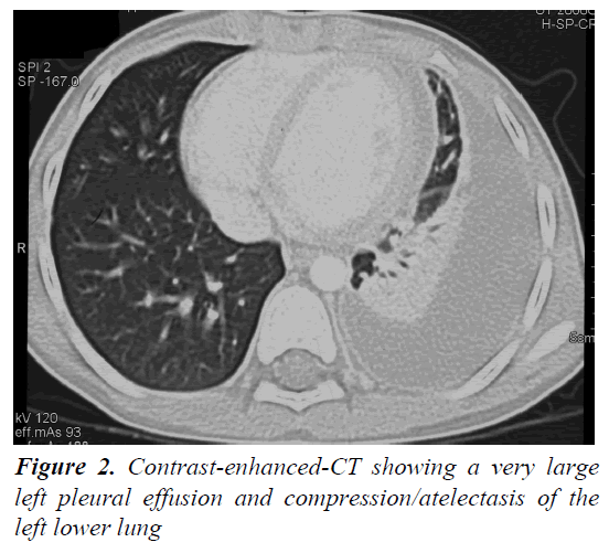 currentpediatrics-compression-atelectasis