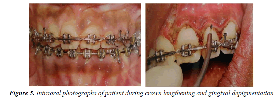 currentpediatrics-gingival-depigmentation