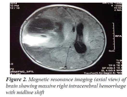 currentpediatrics-intracerebral-hemorrhage