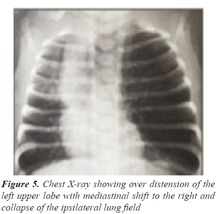 currentpediatrics-ipsilateral-lung