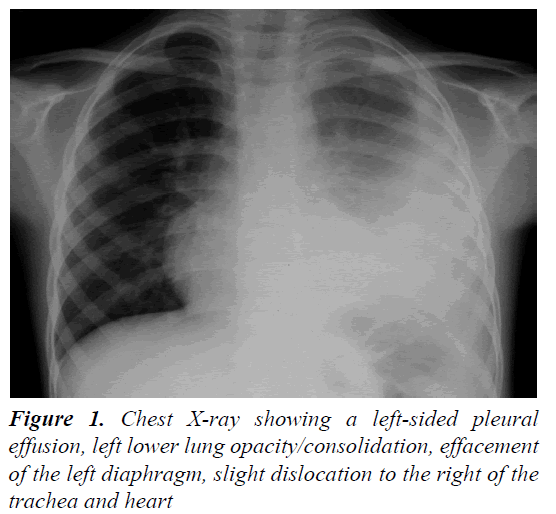 currentpediatrics-left-diaphragm