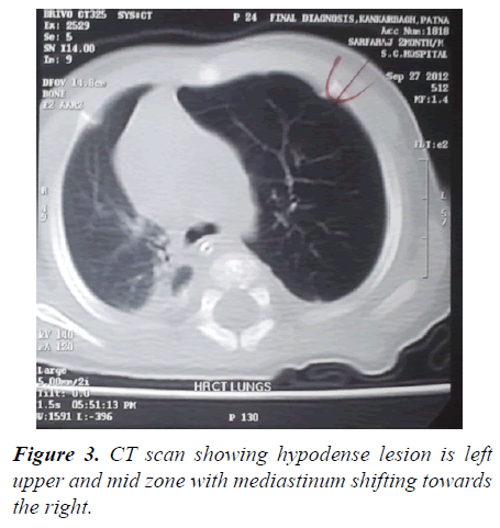 currentpediatrics-mediastinum-shifting